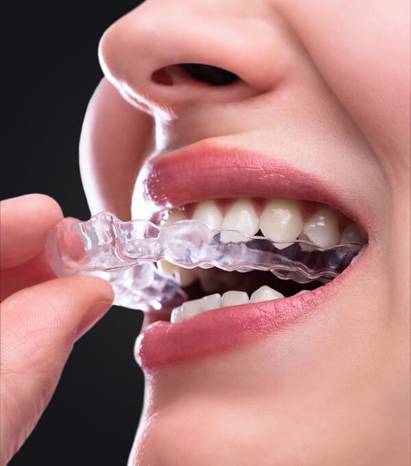 Aligner Tedavisi